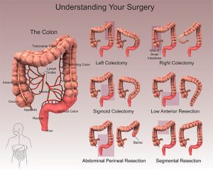 ColonResectioning-SMALL